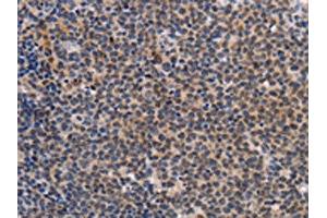 The image on the left is immunohistochemistry of paraffin-embedded Human Lymphoma tissue using ABIN7191963(POU4F1 Antibody) at dilution 1/25, on the right is treated with synthetic peptide.