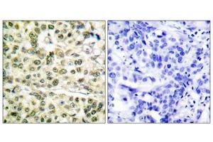 Immunohistochemical analysis of paraffin-embedded human breast carcinoma tissue, using PCNA antibody (ABIN5976487). (PCNA 抗体  (Internal Region))