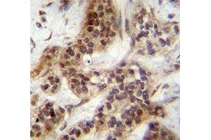 FOXA2 antibody immunohistochemistry analysis in formalin fixed and paraffin embedded human bladder carcinoma. (FOXA2 抗体  (AA 134-163))