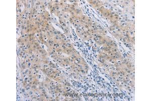 Immunohistochemistry of Human gastric cancer using AGAP2 Polyclonal Antibody at dilution of 1:30 (AGAP2 抗体)