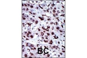 Formalin-fixed and paraffin-embedded human cancer tissue reacted with the primary antibody, which was peroxidase-conjugated to the secondary antibody, followed by AEC staining. (Adenylate Kinase 5 抗体  (N-Term))