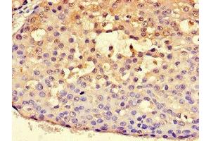 Immunohistochemistry of paraffin-embedded human breast cancer using ABIN7170815 at dilution of 1:100 (HSPA9 抗体  (AA 458-679))