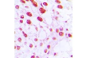Immunohistochemical analysis of DNA Polymerase beta staining in human breast cancer formalin fixed paraffin embedded tissue section. (POLB 抗体  (C-Term))