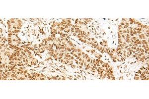 Immunohistochemistry of paraffin-embedded Human ovarian cancer tissue using NHP2 Polyclonal Antibody at dilution of 1:55(x200) (NHP2 抗体)