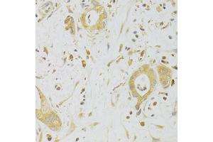 Immunohistochemistry of paraffin-embedded human liver cancer using CASP2 Antibody (ABIN2561574) at dilution of 1:100 (40x lens). (Caspase 2 抗体)
