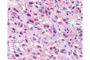 Anti-NPSR1 / NPSR / GPR154 antibody IHC of human Brain, Glioblastoma. (NPSR1 抗体  (Extracellular Domain))