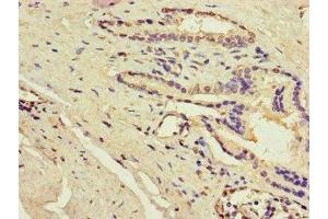 Immunohistochemistry of paraffin-embedded human prostate cancer using ABIN7143204 at dilution of 1:100 (ACSF3 抗体  (AA 365-484))