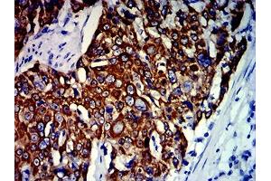 Immunohistochemical analysis of paraffin-embedded esophageal cancer tissues using KRT13 mouse mAb with DAB staining. (Cytokeratin 13 抗体  (AA 104-458))