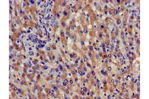 Immunohistochemistry of paraffin-embedded human liver cancer using ABIN7159025 at dilution of 1:100 (SPG21 抗体  (AA 1-308))