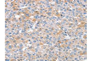 The image on the left is immunohistochemistry of paraffin-embedded Human liver cancer tissue using ABIN7192585(SNX25 Antibody) at dilution 1/35, on the right is treated with synthetic peptide. (SNX25 抗体)