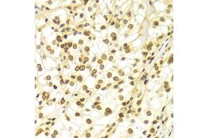 Immunohistochemistry of paraffin-embedded Human kidney cancer using Lamin A/C antibody (ABIN5970079) at dilution of 1/100 (40x lens). (Lamin A/C 抗体)