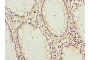 Immunohistochemistry of paraffin-embedded human colon cancer using ABIN7145189 at dilution of 1:100 (B9D2 抗体  (AA 1-175))