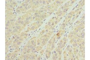 Immunohistochemistry of paraffin-embedded human liver cancer using ABIN7159907 at dilution of 1:100 (TIMM8A/DDP 抗体  (AA 1-97))