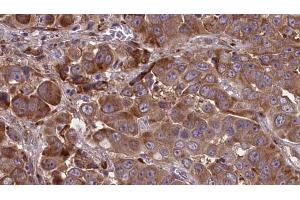 ABIN6273841 at 1/100 staining Human liver cancer tissue by IHC-P.