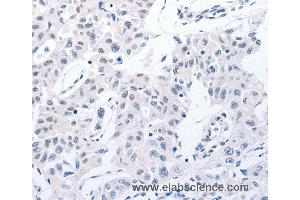 Immunohistochemistry of Human lung cancer using POMC Polyclonal Antibody at dilution of 1:30 (POMC 抗体)