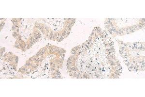 Immunohistochemistry of paraffin-embedded Human liver cancer tissue using HASPIN Polyclonal Antibody at dilution of 1:45(x200) (GSG2 抗体)