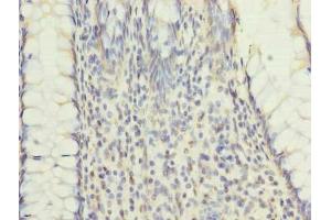 Immunohistochemistry of paraffin-embedded human colon cancer using ABIN7151184 at dilution of 1:100 (RNF26 抗体  (AA 246-433))