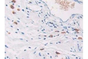 Detection of CEACAM7 in Human Colorectal cancer Tissue using Polyclonal Antibody to Carcinoembryonic Antigen Related Cell Adhesion Molecule 7 (CEACAM7) (CEACAM7 抗体  (AA 147-231))