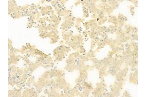ABIN6259921 and ABIN6277899 at 1/100 staining human melanoma by IHC-P.