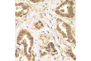 Immunohistochemistry of paraffin-embedded human mammary cancer using ROCK2 antibody. (ROCK2 抗体)