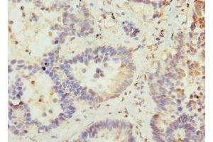 Immunohistochemistry of paraffin-embedded human lung cancer using ABIN7175358 at dilution of 1:100 (VANGL2 抗体  (AA 1-110))