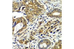 Immunohistochemistry of paraffin-embedded human gastric cancer using CDC16 antibody  at dilution of 1:100 (40x lens). (CDC16 抗体  (AA 371-620))