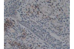 IHC-P analysis of Human Skin Cancer Tissue, with DAB staining. (Angiotensin I Converting Enzyme 1 抗体  (AA 1160-1306))