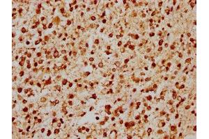 IHC image of ABIN7153409 diluted at 1:200 and staining in paraffin-embedded human glioma performed on a Leica BondTM system. (GABPA 抗体  (AA 268-372))