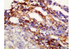 Formalin-fixed and paraffin embedded human lung carcinoma labeled with Anti-TMEM49 Polyclonal Antibody, Unconjugated  at 1:200 followed by conjugation to the secondary antibody and DAB staining (VMP1 抗体  (AA 361-406))