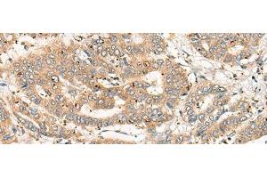 Immunohistochemistry of paraffin-embedded Human liver cancer tissue using CPNE4 Polyclonal Antibody at dilution of 1:40(x200) (Copine IV 抗体)
