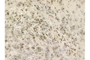 ABIN6258406 and ABIN6275684 at 1/100 staining human melanoma by IHC-P.