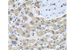 Immunohistochemistry of paraffin-embedded Human liver cancer using GFM1 Polyclonal Antibody at dilution of 1:100 (40x lens). (GFM1 抗体)