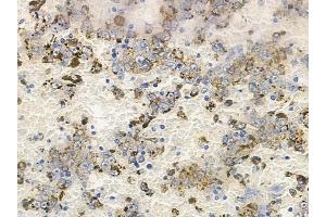 ABIN6263866 and ABIN6272702 at 1/100 staining human melanoma by IHC-P.