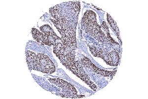 Esophagus Squamous cell carcinoma with strong SOX9 immunostaining of most tumor cells (Recombinant SOX9 抗体  (AA 393-508))