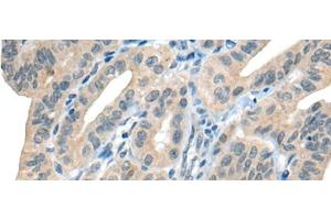 Immunohistochemistry of paraffin-embedded Human thyroid cancer tissue using CHAT Polyclonal Antibody at dilution of 1:30(x200) (Choline Acetyltransferase 抗体)