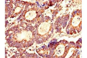 Immunohistochemistry of paraffin-embedded human colon cancer using ABIN7158350 at dilution of 1:100 (LASP1 抗体  (AA 128-252))