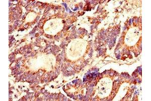 Immunohistochemistry of paraffin-embedded human colon cancer using ABIN7158350 at dilution of 1:100