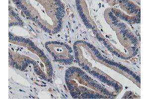 Immunohistochemical staining of paraffin-embedded Adenocarcinoma of Human colon tissue using anti-ATG3 mouse monoclonal antibody. (ATG3 抗体)