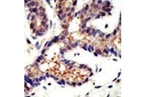 Formalin-fixed and paraffin-embedded human cancer tissue reacted with the primary antibody, which was peroxidase-conjugated to the secondary antibody, followed by DAB staining. (Ubiquilin 3 抗体  (N-Term))