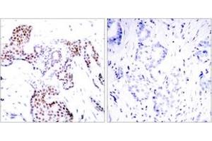 Immunohistochemistry analysis of paraffin-embedded human breast carcinoma, using Elk1 (Phospho-Ser389) Antibody. (ELK1 抗体  (pSer389))