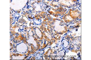 Immunohistochemistry of Human liver cancer using AP1B1 Polyclonal Antibody at dilution of 1:100 (AP1B1 抗体)
