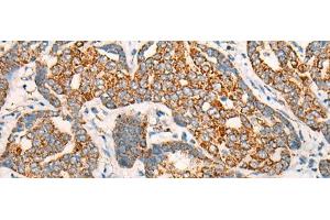 Immunohistochemistry of paraffin-embedded Human liver cancer tissue using CCT8L2 Polyclonal Antibody at dilution of 1:45(x200) (CCT8L2 抗体)