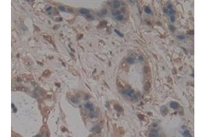 Detection of gp210 in Human Pancreatic cancer Tissue using Polyclonal Antibody to Nuclear Pore Glycoprotein 210 (gp210)