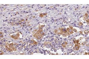 ABIN6272590 at 1/100 staining Human liver cancer tissue by IHC-P. (IL31RA 抗体  (Internal Region))