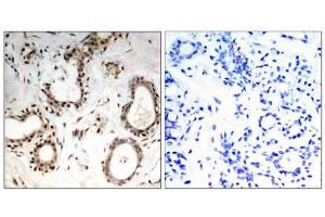 Immunohistochemical analysis of paraffin-embedded human breast carcinoma tissue, using HSF1 (Ab-307) antibody (E021206). (HSF1 抗体)