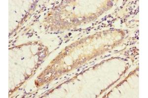 Immunohistochemistry of paraffin-embedded human colon cancer using ABIN7143328 at dilution of 1:100 (ADCY4 抗体  (AA 808-1077))