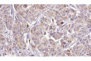 ABIN6277257 at 1/100 staining Human Melanoma tissue by IHC-P. (IL-8 抗体  (Internal Region))