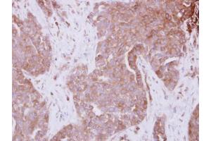 IHC-P Image Immunohistochemical analysis of paraffin-embedded AdCA xenograft, using STAM, antibody at 1:500 dilution. (STAM 抗体  (Center))