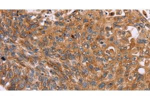 Immunohistochemistry of paraffin-embedded Human esophagus cancer tissue using PMPCB Polyclonal Antibody at dilution 1:50 (PMPCB 抗体)