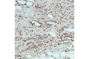 Immunohistochemical analysis of CALHM1 staining in human Hepatocancer formalin fixed paraffin embedded tissue section. (CALHM1 抗体)